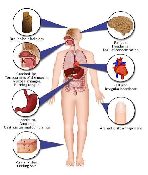 A Simple Guide to Iron Deficiency